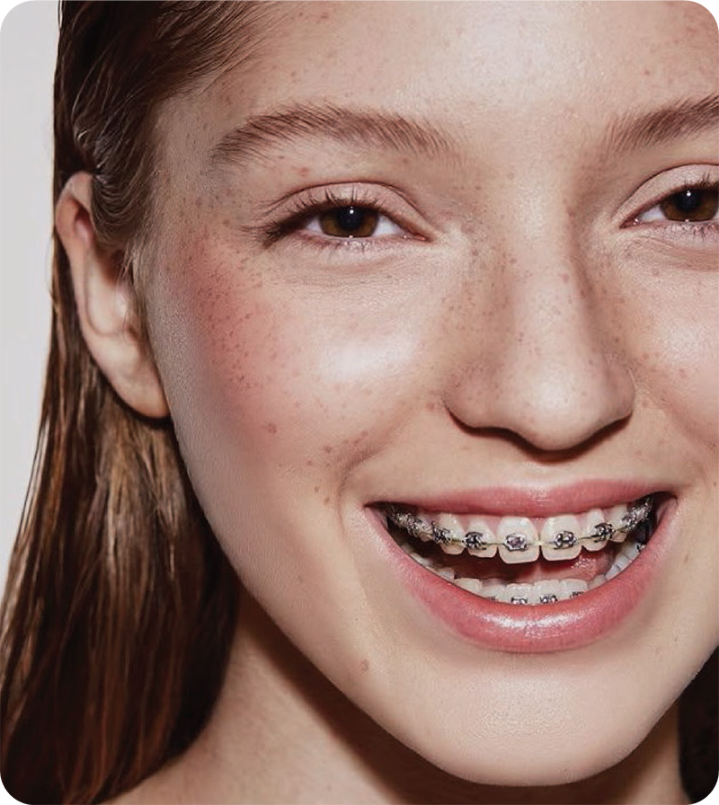 Braces