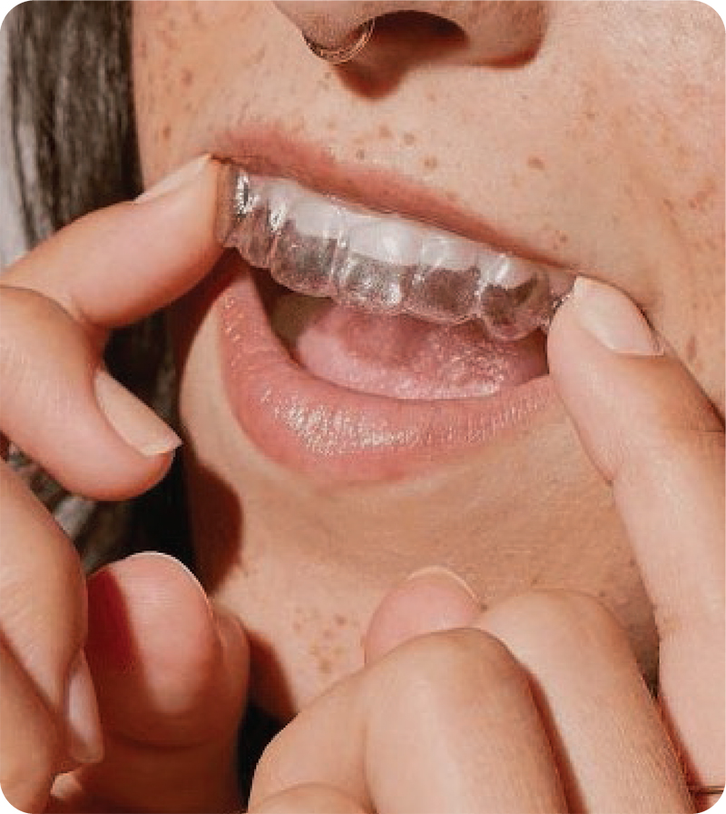 Clear Aligners