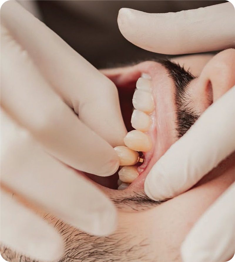 Dental Implants