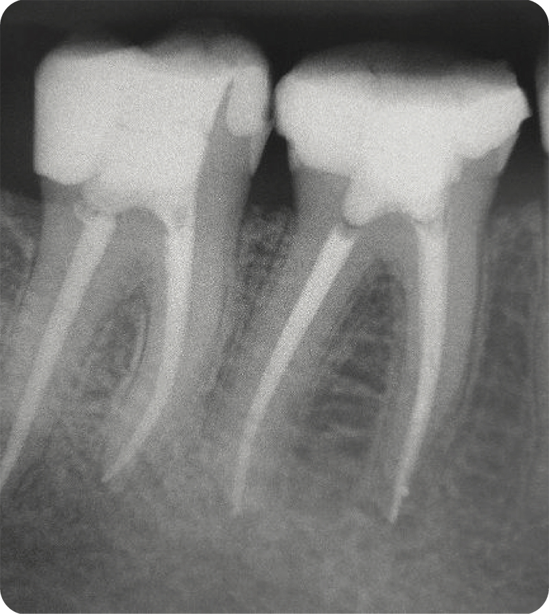 Root Canal Treatment