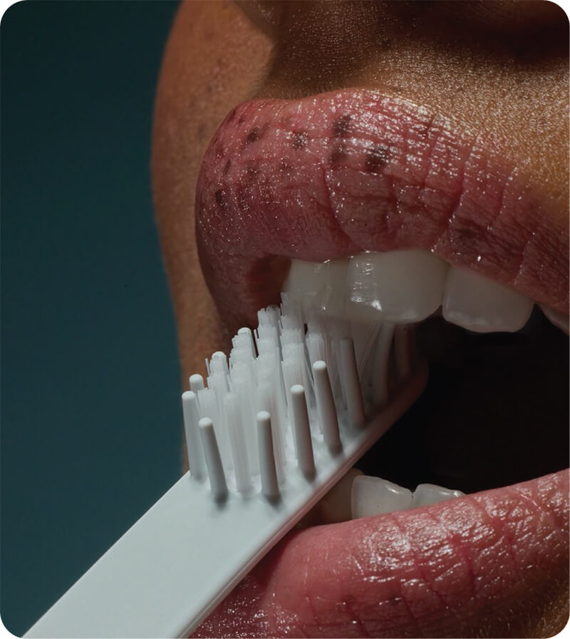 Teeth Whitening